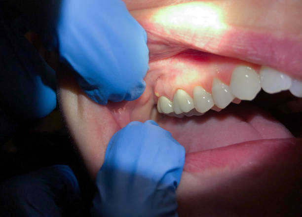 Best Emergency Treatment for Dental Infections or Abscesses in Reform, AL